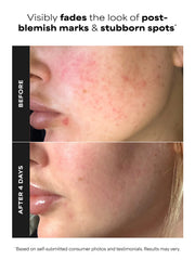 10% Azelaic Acid Booster